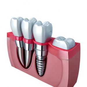 China Elevating Standards Our Dental Implant Crown Quality Assurance on sale