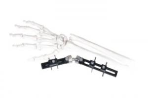 China Straight Pin Type Wrist Medical External Fixator minimal interference with soft-tissue wholesale