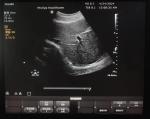 ATL Clearvue original convex array ultrasound probe C5-2