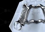 High Strength 3D Printed Titanium Framework With Clear Clasps For Durable