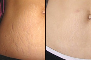Acne Treatment RF Microneedling Machine Skin Tighting 0.2mm-2mm depth
