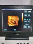 USG OB GYN Portable USG Machine IMT Automatic Measurement