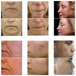 2016 best professional skin tightening face lifting Micro-needle Fractional RF