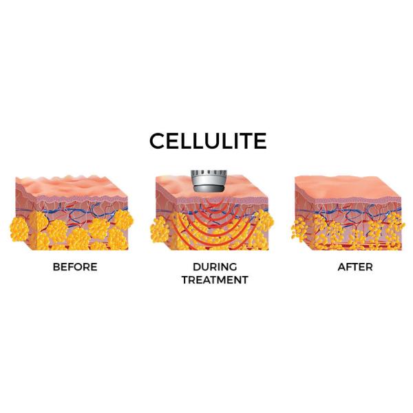 High Intensity Extracorporeal Shock Wave Therapy Equipment For Cellulite Treatments