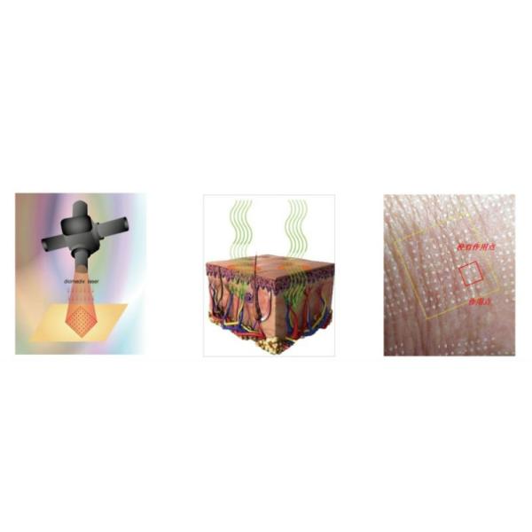 CO2 Fractional Laser Scar Removal Fractional Laser Skin Renewing/ Skin Rejuvenation Resurfacing/ Skin Renewing