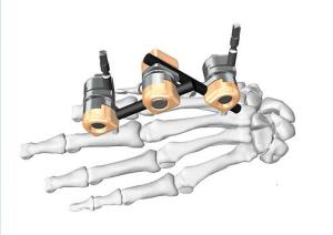 China Stable External Fixation System Dissection IV Φ5- Children’S Metacarpale Fixation wholesale