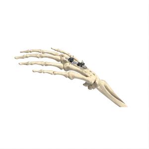 China Soft Tissue Correction Mini External Fixator Mini Ex Fix 1.6mm 2mm Pin on sale