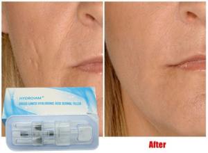 China Hyaluronic Acid Injectable Filler 10ml For Lip Injection Cheeks Chin Augmentation on sale