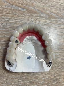 China Cement Teeth Implant Dental Bridge PFM Screwed Metal Porcelain wholesale