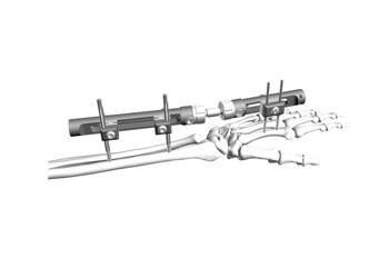 Distal Radius External Fixation System Minimal Interference With Soft Tissue