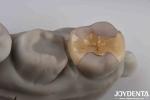 Low Translucency Inlay Onlay Secure Cementation For Long-Lasting And Aesthetic