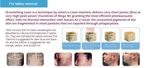 Professional Active Q-Switch Nd yag Laser machine laser tattoo removal machine